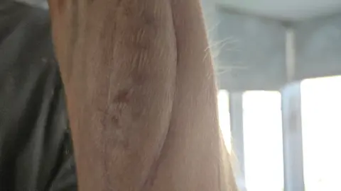 PA Media The arm of Darren White, 53, from Stockton-on-Tees, who is one of the first lung transplant patients in the UK to have a patch of their organ donors skin grafted onto their forearm in the hope that it could help medics spot signs of the lung being rejected by the body sooner.