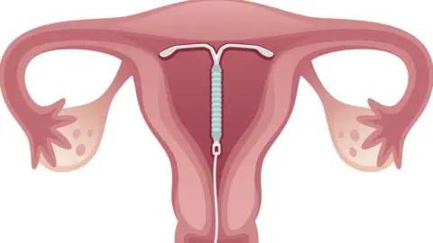 Getty Images diagram showing coil in the womb