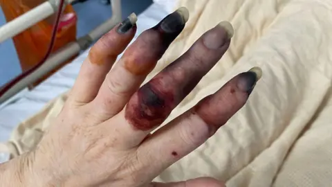 Louise Marshallsay A hand with four blackened fingers due to sepsis 