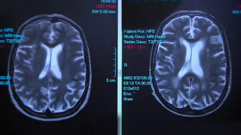 BBC Brain scans of the same person, eight years apart, the enlarged white areas on later scan on the right are alcohol damage