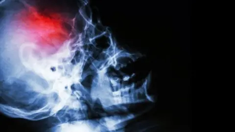 Getty Images Scan image of brain