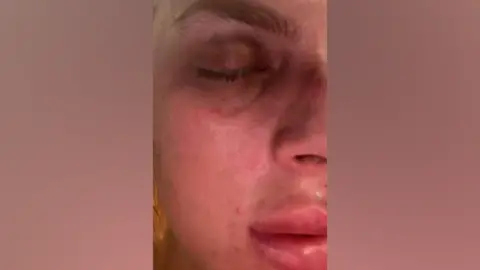 Wales News Service Bruises