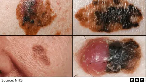 NHS Melanoma pictures