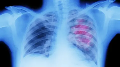 Peter Dazeley Scan of a person's chest with a red area around the left lung.