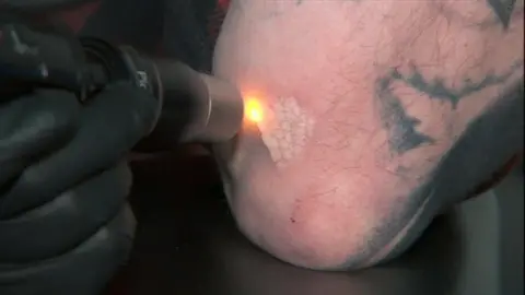 A close up of a red laser dot directed at a tattoo on a man's arm. It is unclear what the tattoo was of, but you can see an area of black ink. Where the laser has already been directed, the skin is slightly raised and white.