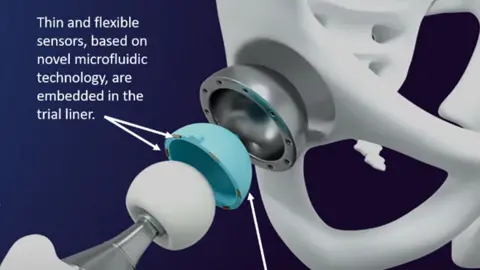 An exploded view of the thin and flexible sensors and the “intelligent” trial liner