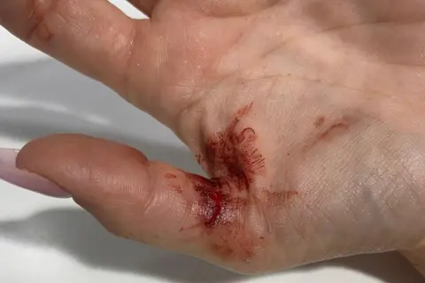 Meadow House Part of a hand is seen with blood staining and a cut between the thumb and forefinger.