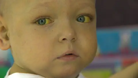 Two-year-old Zachary Bradford looks into the distance, his blue eyes tinged in yellow from his liver condition