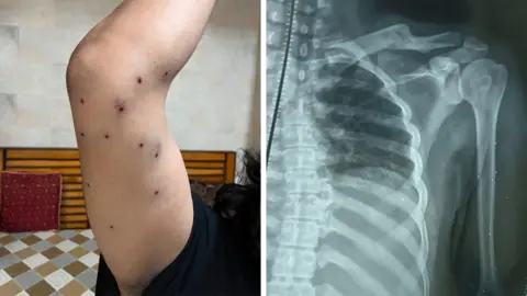 User generated A 28-year-old journalist has shared his photos and X-ray with the BBC 