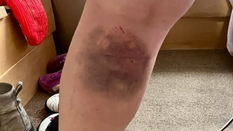 A large bruise on a woman's lower leg. The bruise is almost the width of her calf and scratches can be seen. Pairs of shoes and a bench can be seen in the background.