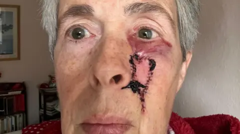 Lis Dales A close-up picture of Lis Dales' face the day after her operation to remove a basal cell carcinoma. There is a purple scar under her left eye, below which is a series of stitches surrounding a patch of skin on her cheek, some of which is covered in congealed blood.