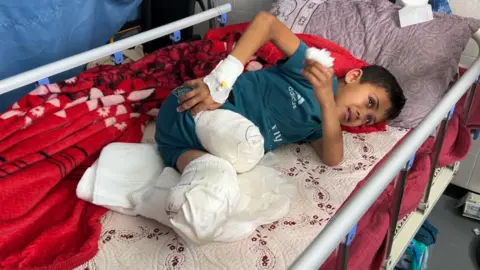 A young boy named Yassin al Ghalban lies on a hospital bed in bandages, with both legs amputated below the knee