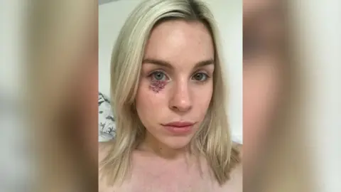 A young woman with shoulder length blonde hair with a red scar and scar tissue under her right eyelid.
