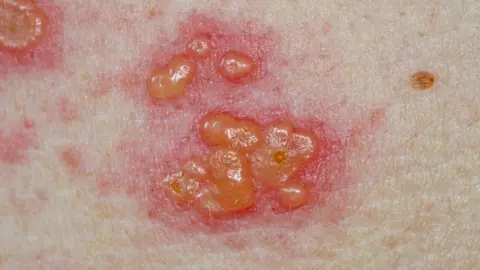  DR P. MARAZZI/SCIENCE PHOTO LIBRARY Image of Shingles which includes blotchy, blisters.