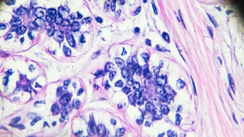 Getty Images breast cancer slide