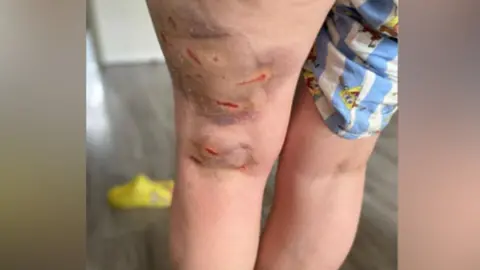 Rosie's legs can be see in the centre of the photo. Her left leg has red marks from fresh scars and heavy dark coloured bruising. On her right leg her blue and white shorts can be seen. There two yellow shoes on the floor.