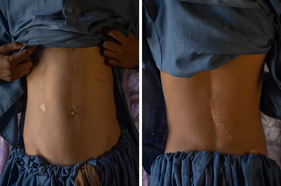 BBC Scars on Imran's abdomen show the damage from the bullet wound as well as his surgical incision. Image: Julian Busch/BBC