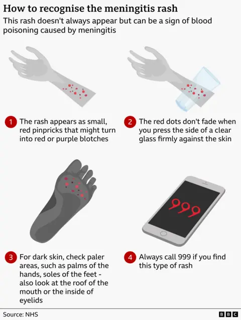 An infographic titled “How to recognise the meningitis rash.” It explains that the rash may signal blood poisoning caused by meningitis. The graphic shows an arm with small red pinprick spots. Step 1 notes that the rash appears as tiny red dots that may develop into red or purple blotches. Step 2 illustrates a clear glass being pressed against the rash, with text saying the spots do not fade under pressure. Step 3 shows a dark‑toned arm with highlighted areas, advising that on darker skin the rash is best checked on paler areas such as the palms, soles of the feet, the roof of the mouth, or inside the eyelids. Step 4 shows a phone displaying “999” and instructs to call emergency services immediately if this type of rash is present. Source: NHS