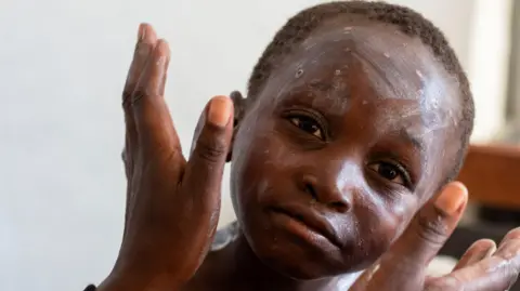 Reuters Medicamento aplicado no rosto de uma criança com mpox - uma doença infecciosa que causa uma erupção cutânea dolorosa - em um centro de saúde em Munigi, território Nyiragongo, perto de Goma, na província de Kivu do Norte, na República Democrática do Congo.