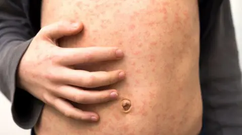 A child's torso covered in the red spots of a measles rash