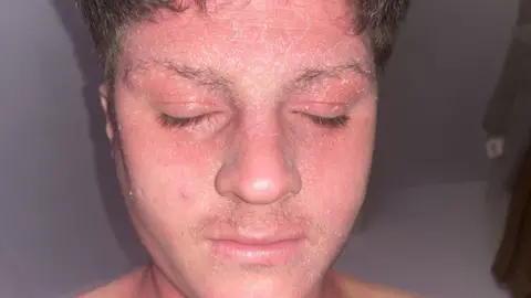 A close up of a brown haired man's face, with several dry, flakey patches of skin.