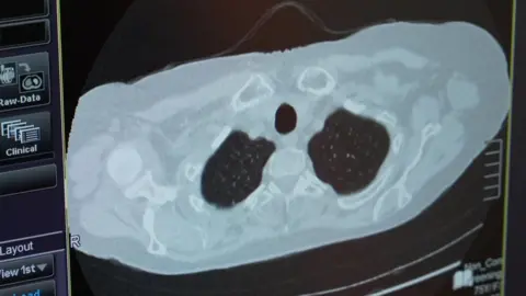 BBC Lung scan