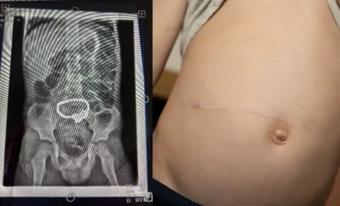 Supplied photo / BBC Jude's x-ray and five-inch scar