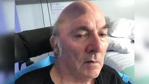 Family photo Roger Jones in hospital after having part of his skull removed, showing a deep indentation on the top of his head
