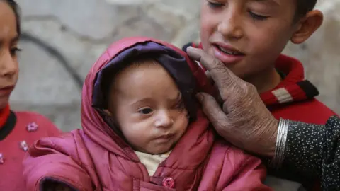 Getty Images [EDITORS NOTE: Image depicts graphic content] A Syrian baby Karim is seen with wounds on his head in the besieged Eastern Ghouta, Syria on 15 December 2017