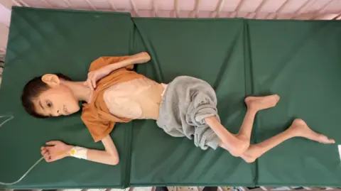 BBC Emaciated child lies on green hospital bed