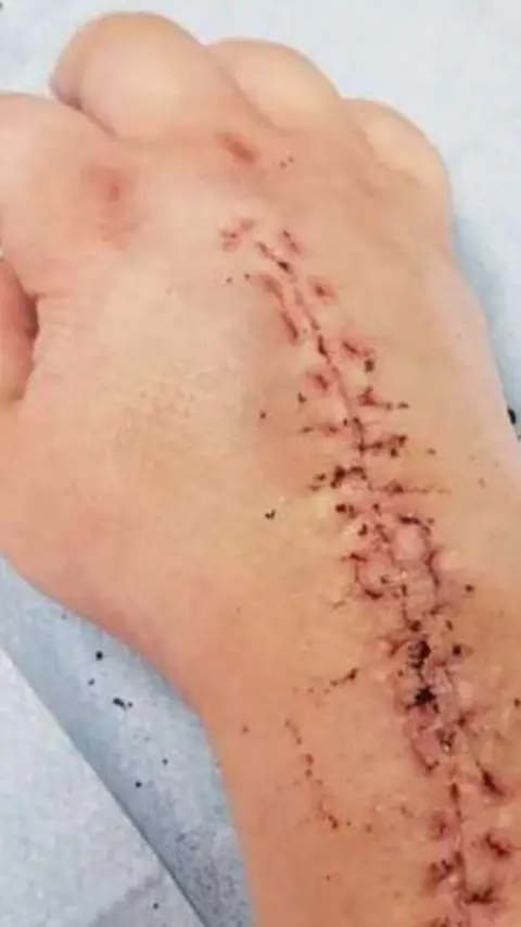 Supplied Georgia's wrist, which appears to have been recently operated on. It appears to be resting on a hospital bed. It shows a large scar and evidence of stitches and dried blood.