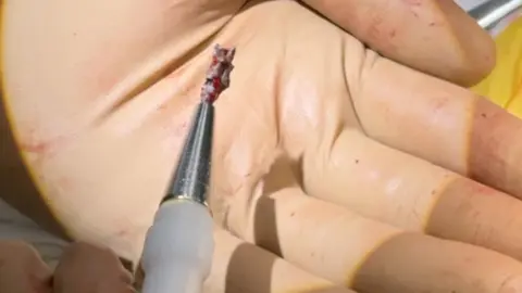 Dnipro cardiac center The shrapnel that was in Serhiy's heart attached to the magnetic extractor that removed it.