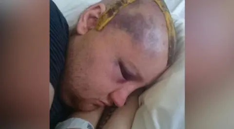 David Bown David Bown is lying in a hospital bed asleep. The shot shows a close-up of his head.