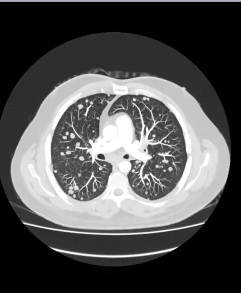 Nathaniel Dye A medical scan of a cross section of Nathaniel's lungs showing dozens of cancerous tumours