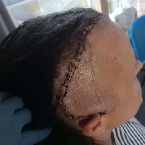 A woman's shaved head with a long scar across the side of it