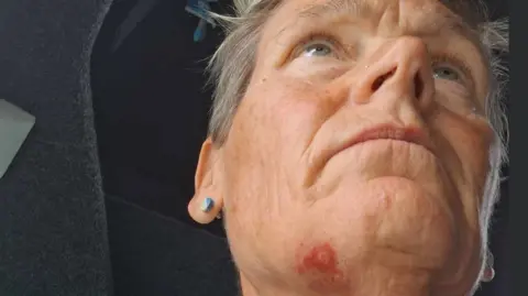 Nikki Cullis Nkki Cullis with jellyfish burn on her face. She has grey hair and is wearing blue and green earrings 