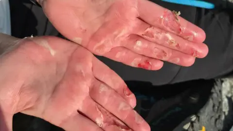 kelbowbaggins Two hands can be seen with severe injuries. The skin has been completely ripped away from their fingers and blistering is starting to take place.