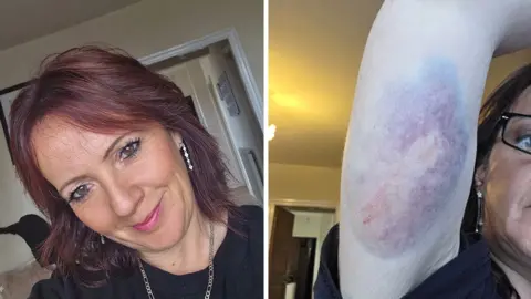 Melanie Moore Two images of Melanie Moore side by side. The left is a selfie, she is smiling and has long layered dark red hair and the right shows under her right arm with extensive bruising