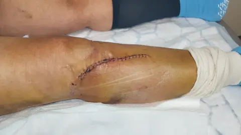 Giuliana Rossi Guiliana's knee with stitches and a lot of bruising around the area where the cut was made. She also has other bruises on her calf. 