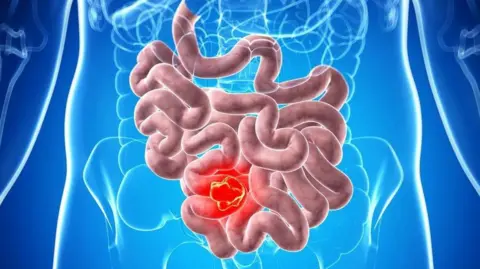 Graphic showing the bowel and intestines. The intestines are shown as brown and the bowel depicting cancer is coloured bright red. The rest of the mid section of the body is blue