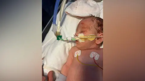 Family handout A baby lying on a bed in hospital. Tubes run from her face and chest.