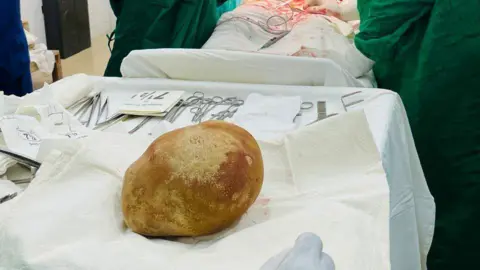 Trincomalee General Hospital Close-up shot of the giant yellow bladder stone 