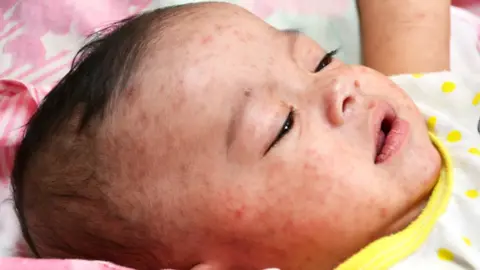 SPL Baby with measles