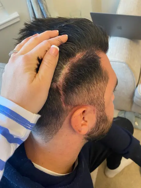 Ellie James A man's hair is pushed to the side to reveal a large scar running across his head from surgery.