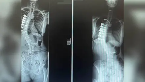 handout Two x-rays of Ms Ellis' spine