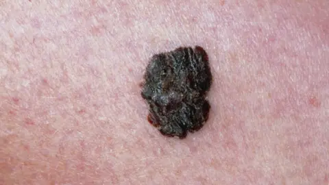 Science Photo Library Mole on skin melanoma