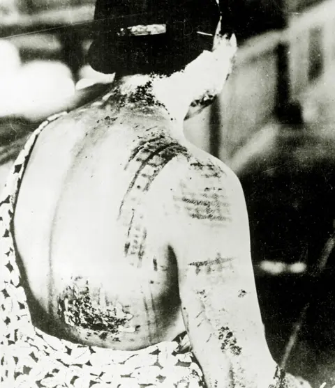 Getty Images A woman shows burns on her neck, shoulders and back