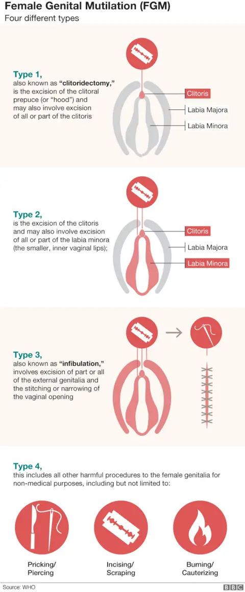 Graphic showing different types of FGM