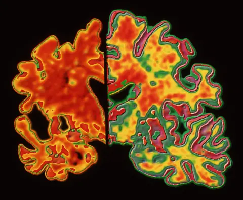 Science Photo Library Comparative images of the brain of a dementia patient and a non-dementia patient