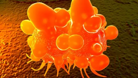 Getty Images Bowel cancer cell